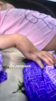 В Иванове неврологи вернули 5-летней пациентке подвижность кисти 